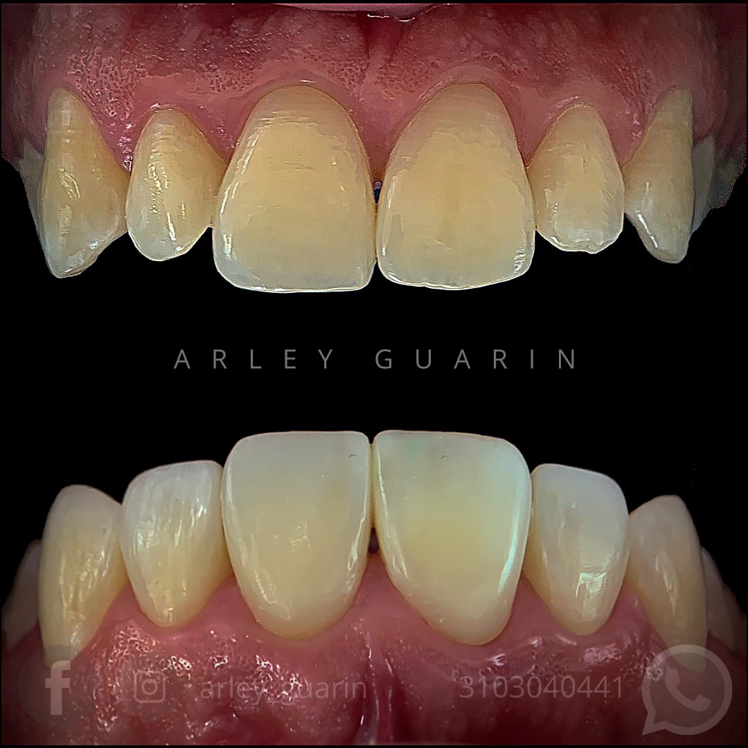 Caso real de antes y después dental